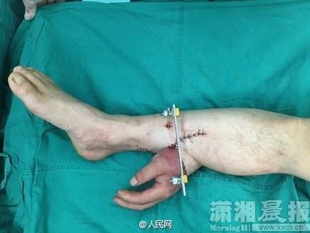 Mão decepada em acidente é implantada em perna de paciente; Entenda