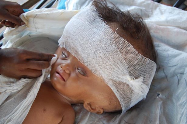 Bebê luta pela vida após sofrer crescimento desenfreado da cabeça que triplicou de tamanho por causa de rara condição