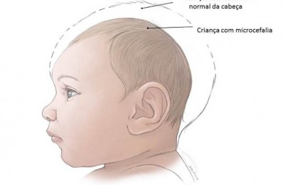 Ministério da Saúde investiga casos de microcefalia na PB