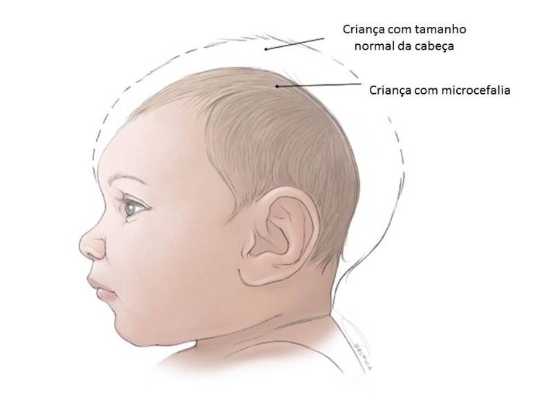 Ministério da Saúde investiga casos de microcefalia na PB