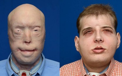 Bombeiro passa pelo maior transplante de rosto já realizado