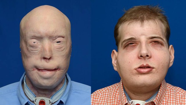 Bombeiro passa pelo maior transplante de rosto já realizado