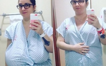 Jornalista supera doença que faz a mama ficar gigante e retira 6 kg de seios