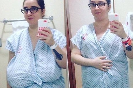 Jornalista supera doença que faz a mama ficar gigante e retira 6 kg de seios