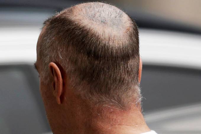 Eike usa há dez anos película de silicone para esconder calvície